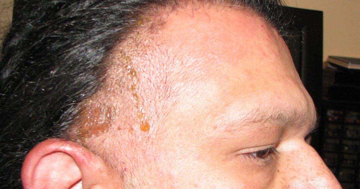 Dangerous Hair Dye May 28 2009 Hair Dye Allergy Reaction dangerous-hair-dye-may-28-2009-hair-dye-allergy-reaction