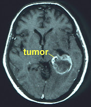 Tumor Cerebral