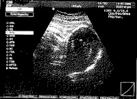 Baby Noel in mommy's stomach