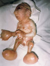 bambini uranizzati nati dopo bombardamenti Nato