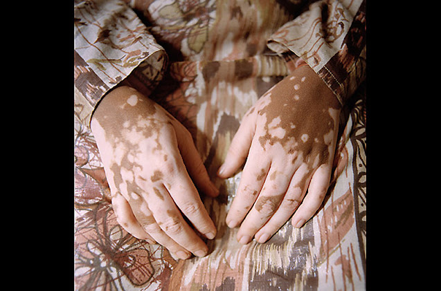 World Vitiligo Day - Ημέρα Λεύκης