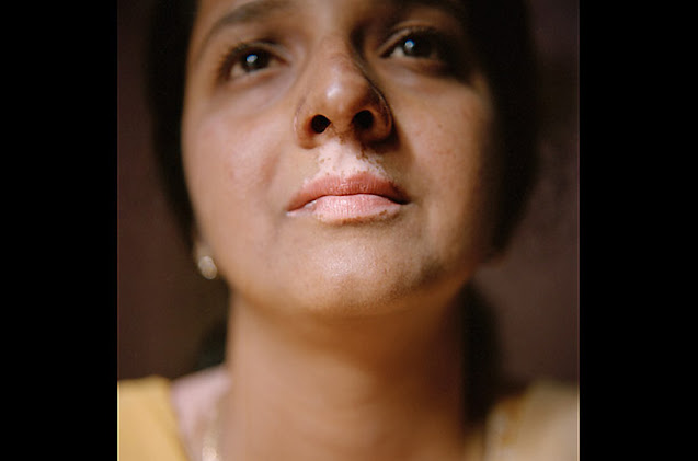 World Vitiligo Day - Ημέρα Λεύκης