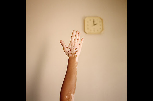 World Vitiligo Day - Ημέρα Λεύκης