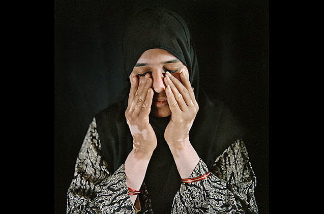 World Vitiligo Day - Ημέρα Λεύκης