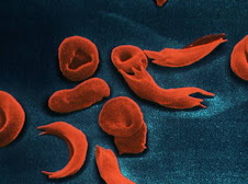 globulos rojos falciformes