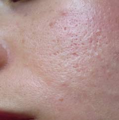 [sivilce-izleri.jpg]