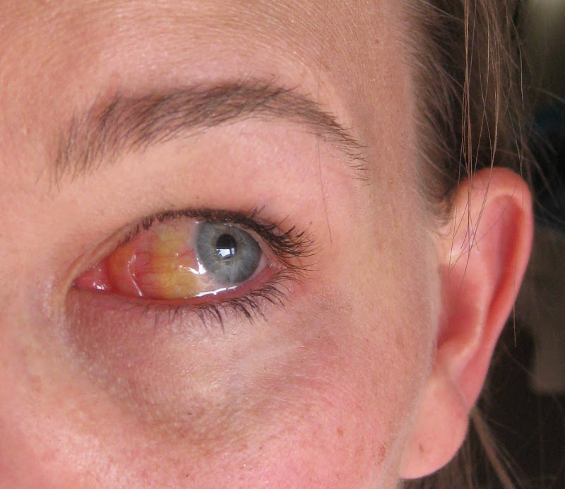 The jonesy files scleral edema or swollen eyeball