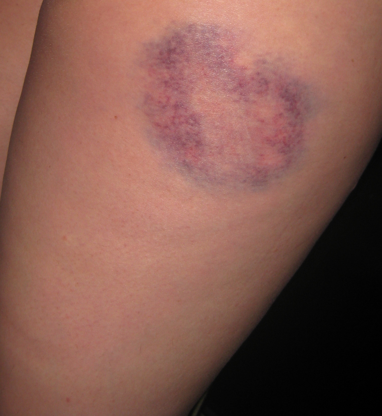 mm-injuries-on-pinterest-lady-gaga-face-wound-healing-and-special