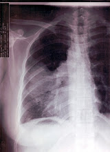Left lung x-ray on April 08