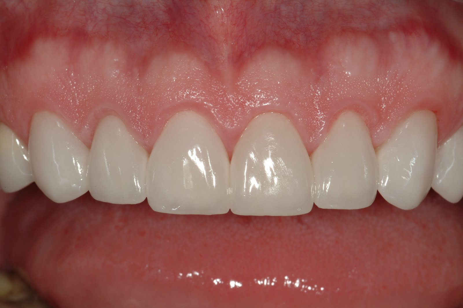 Dental Material Matters: Self Adhesive Cements and Self Adhesive