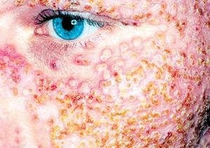 eczema+on+face.JPG