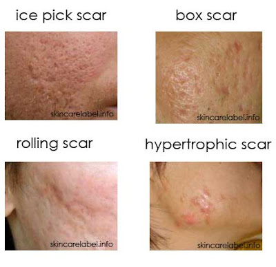 What Are the Treatments for Rolling Acne Scars? Healthfully
