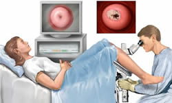 cin3 cin2 cin1: colposcopy