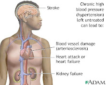 Untreated hypertension damages vessels, heart and kidneys