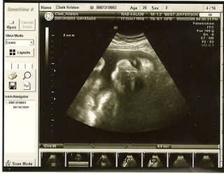 Our Baby Clark...: Week 33 High-Risk Ultrasound