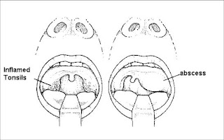 Hasil gambar untuk abses peritonsil