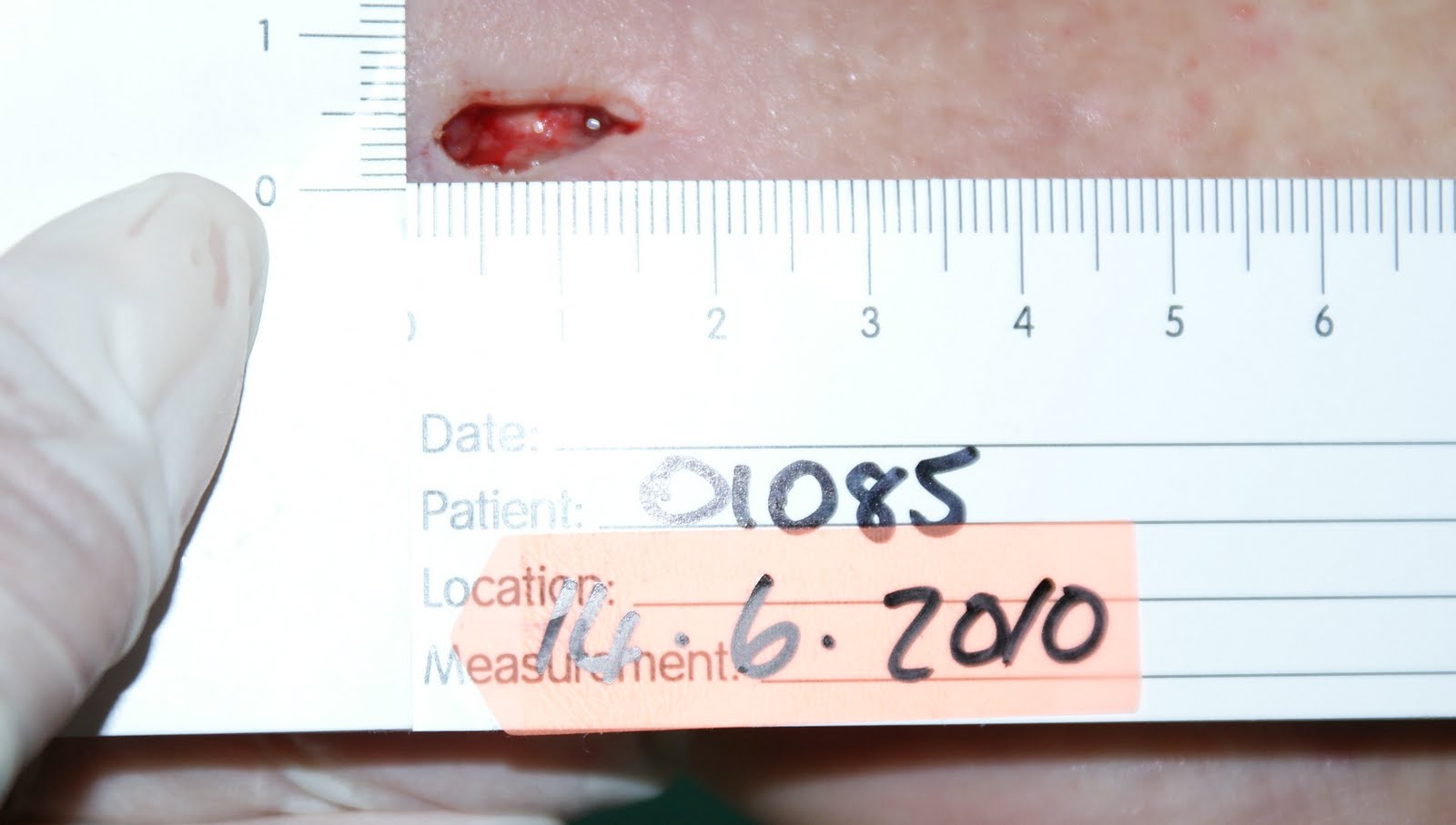 The Wound Healer Elective use of maggots in septic diabetic foot