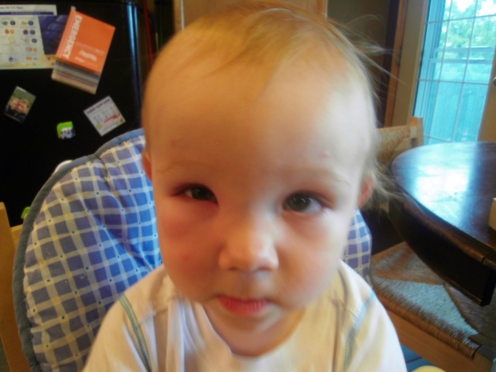 Shane and Tara's Photo Gallery Swollen Eye!!! From new bug bite on his