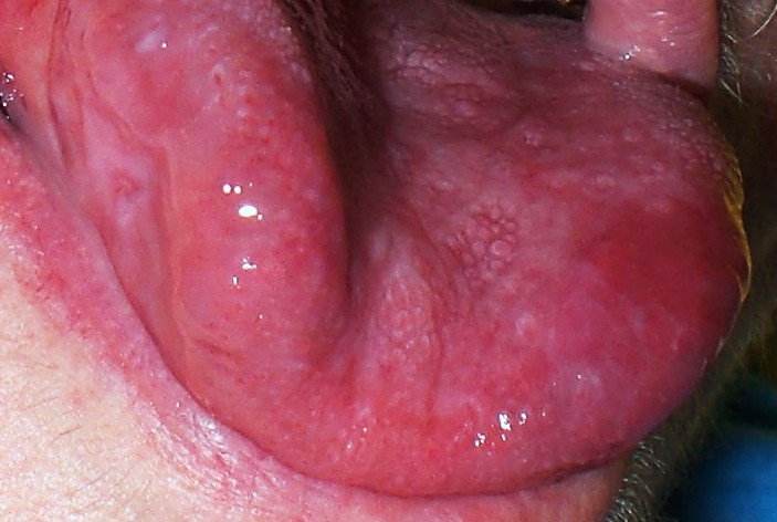 Swollen Mouth Tissue 75
