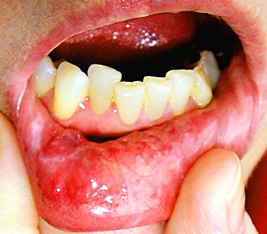 Lower Mouth 65