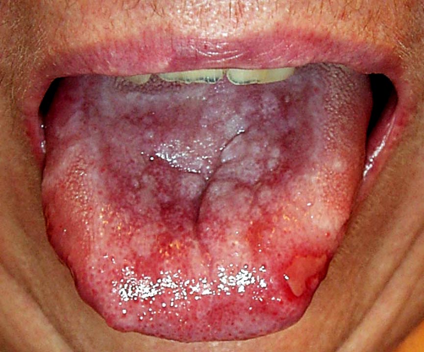 Canker Sore Pictures on the Lip, Mouth, Gums and Tongue.