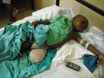 [ni%C3%B1o+pierna+izquierda+amputada.JPG]