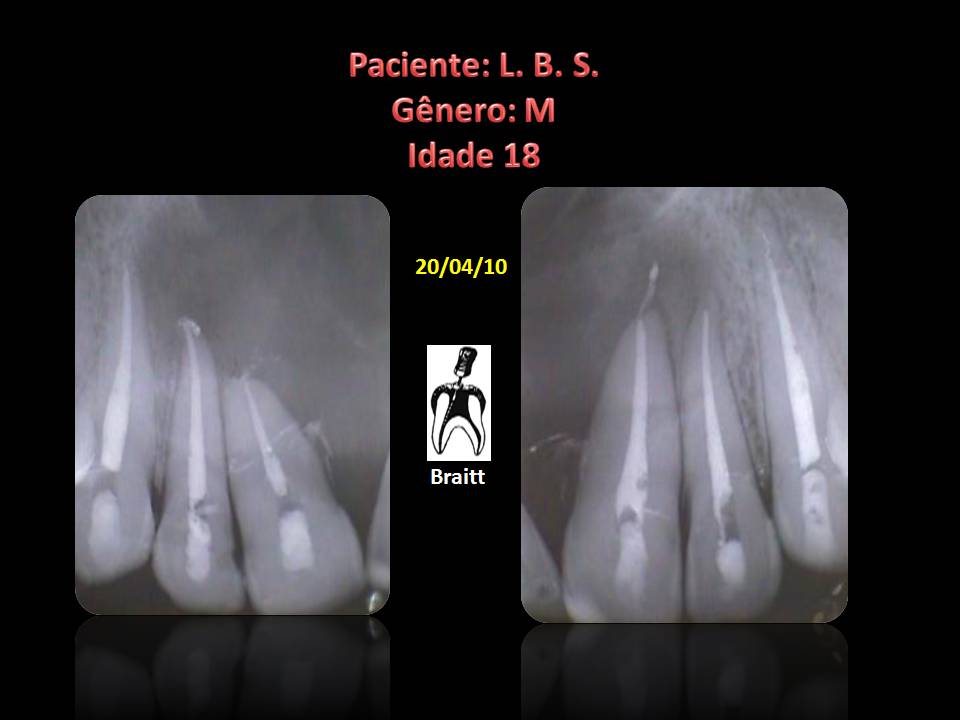 Endodontia Dr Henrique Braitt Tratamento endodôntico de grande lesão no periodonto apical