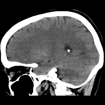 basal ganglia calcification, possible fahrs syndrome