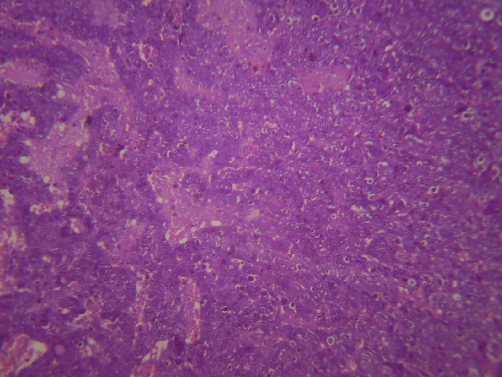 My Pathology non seminomatous germ cell tumor [ embryonal ca, yolk