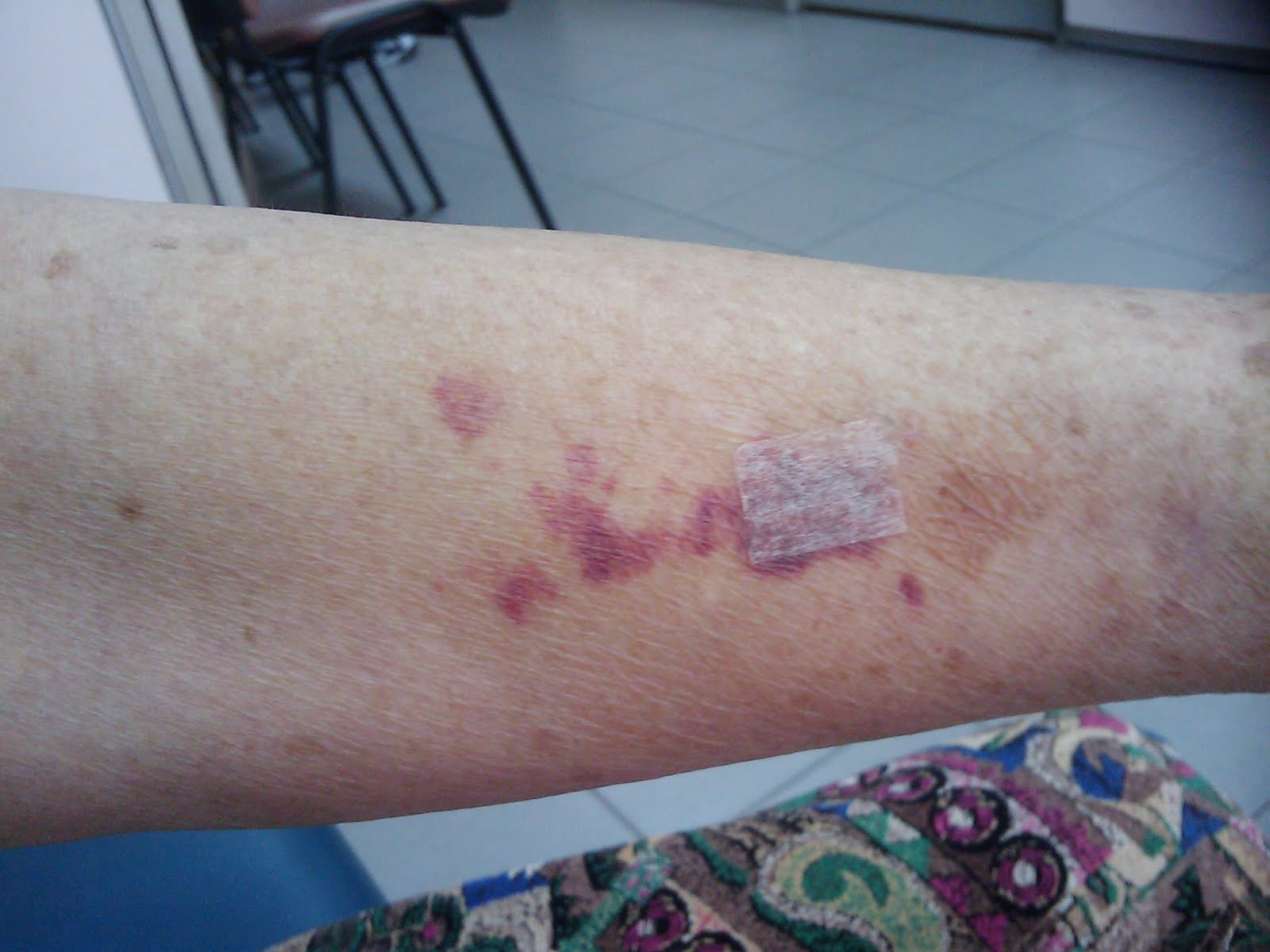 show-and-solve-your-problem-skin-spontaneous-bruises-in-an-elderly