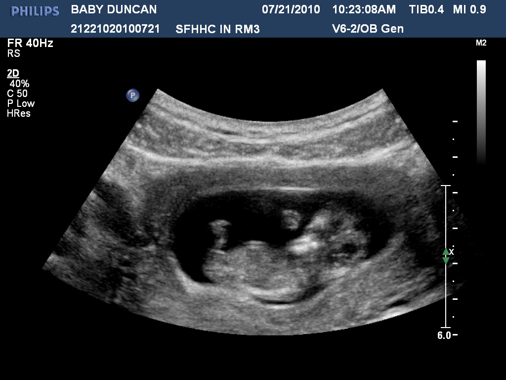 Rooney Adventures in Pregnancy 11 weeks ultrasounds and 3ds