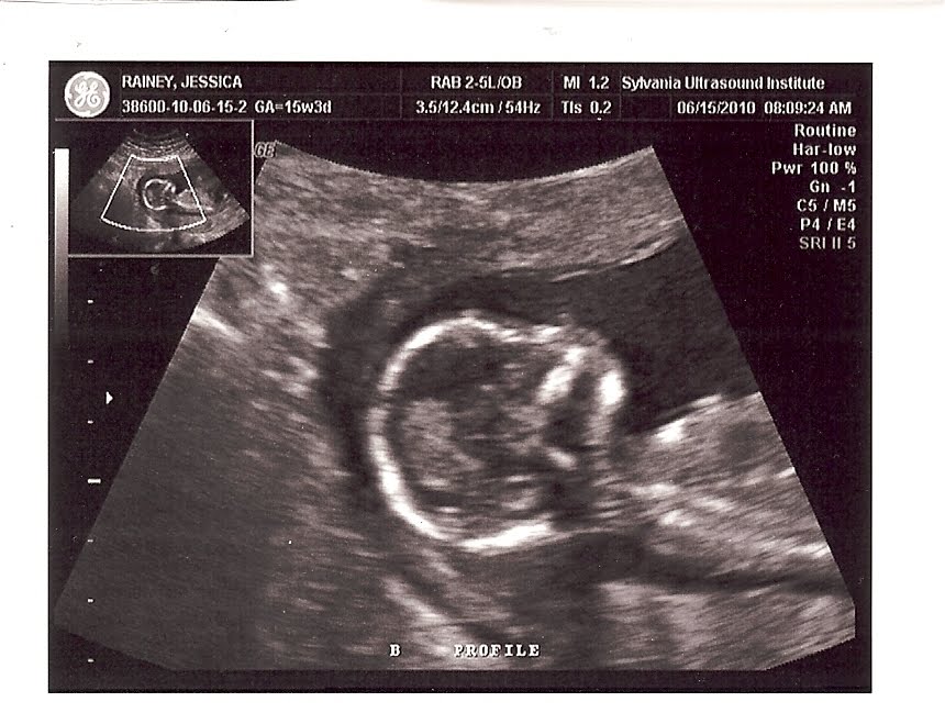 Raising the Rainey Twins: 15 week ultrasound