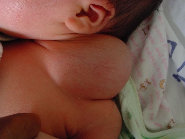 Arwil The Golden Boy Higroma Kistik