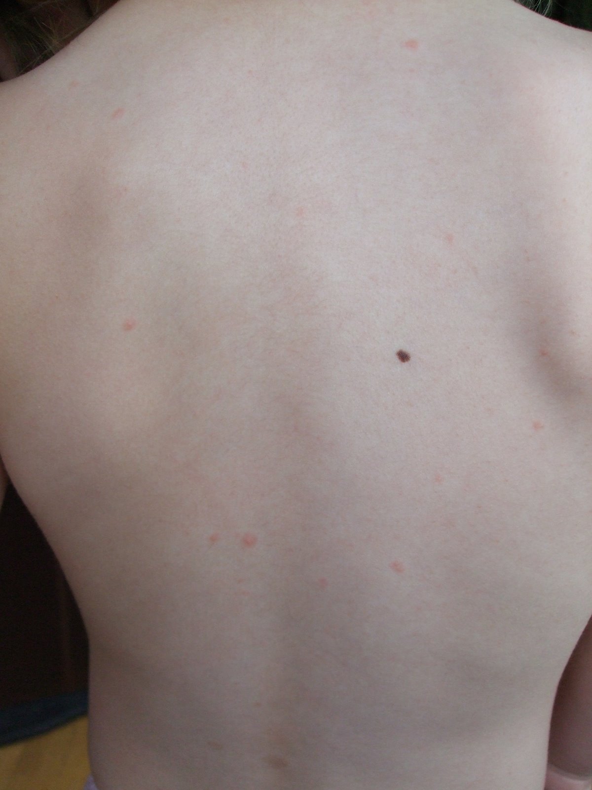 What Are the First Signs of Chickenpox? | New Health Advisor