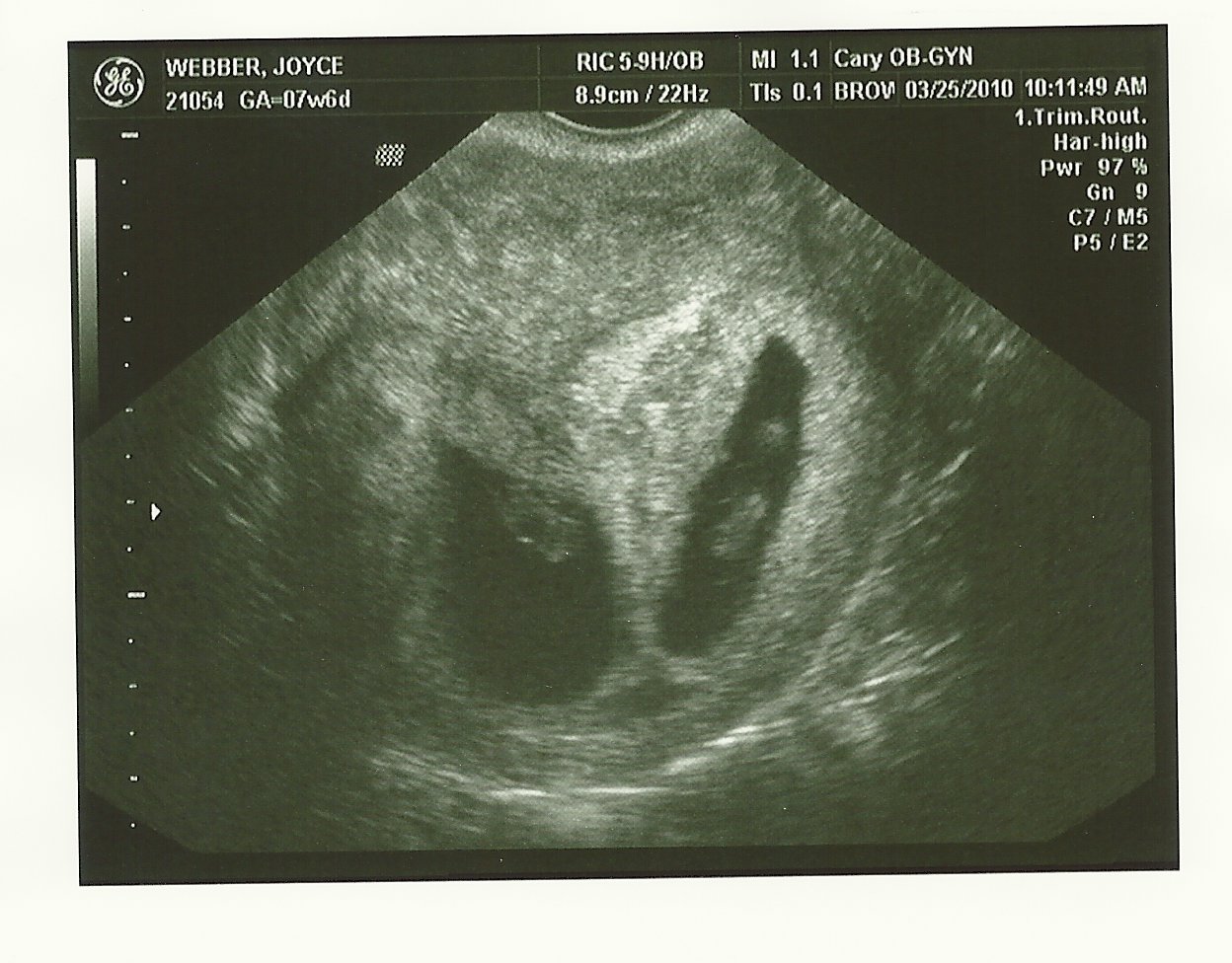 8 week sonogram 8 week sonogram