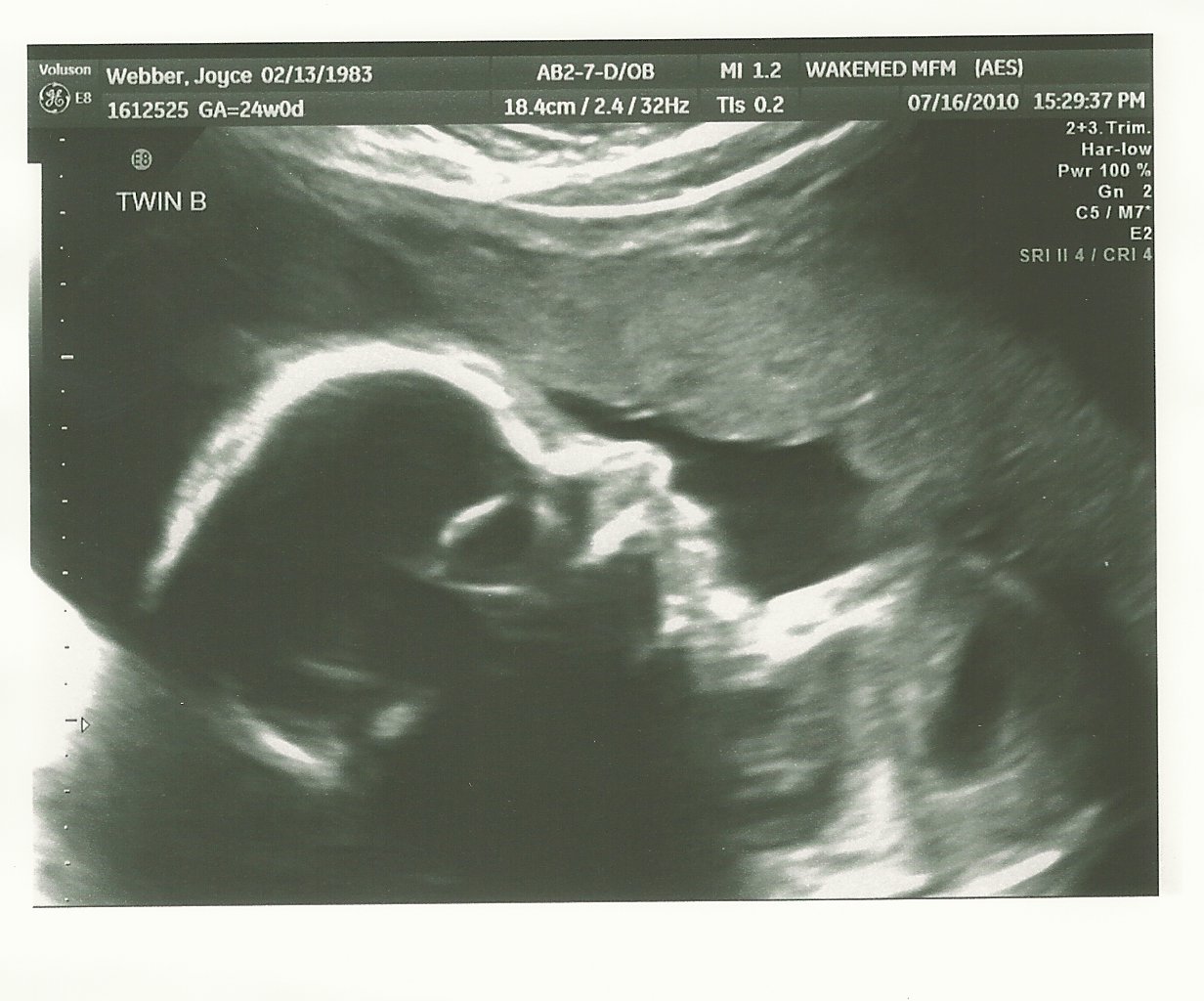 Ash & Lee Plus 3 24 Week Ultrasound