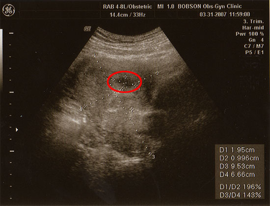 sonogram 5 weeks. 12 5 week ultrasound.