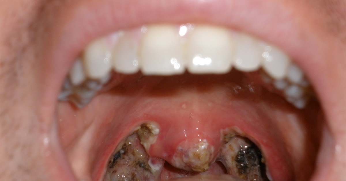 tonsils adult throat Sore