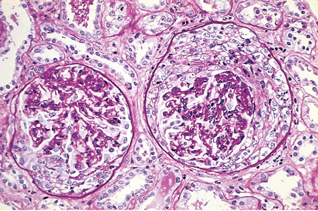 Rapidly Progressive Glomerulonephritis (RPGN). | Geoffrey E. Reed life