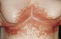 Candida albicans