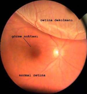 retina dekolmanÄ± ile ilgili gÃ¶rsel sonucu
