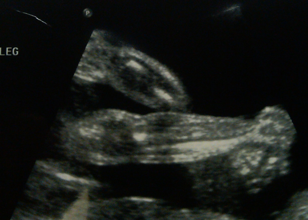 Our walk with Trisomy 18 27 week ultrasound
