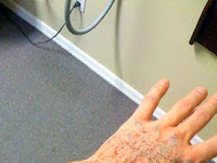 Does Laser Tattoo Removal Scar Your Skin
