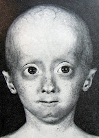 progeria family circle: progeria