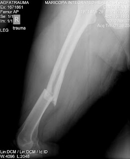 cadaver femur break cadaver femur break