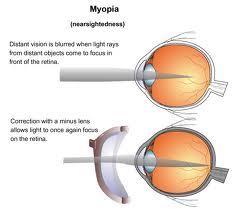 HEALTHY: Myopic Vision and Tight Eye Muscles