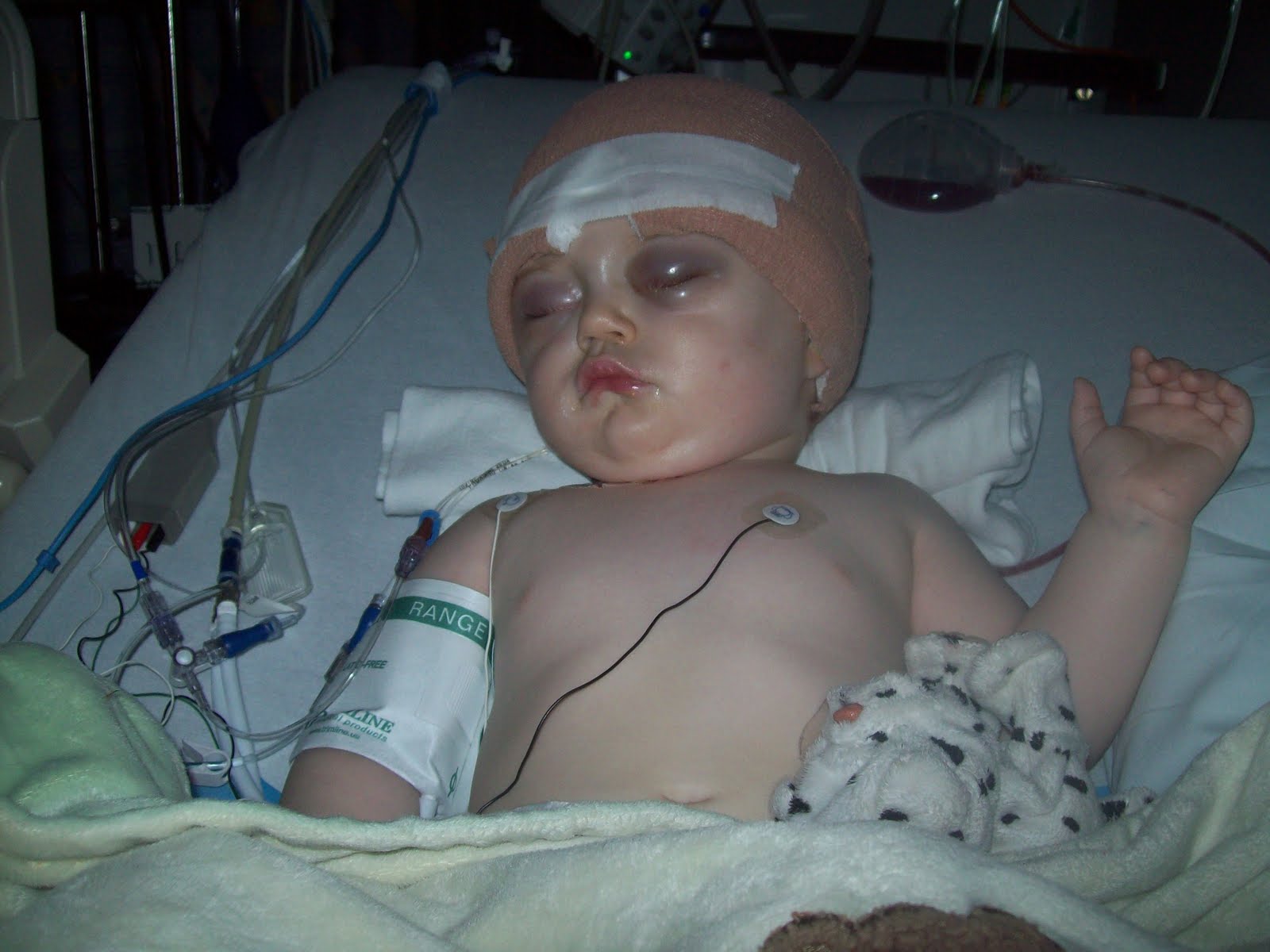 I'm really hoping this is the worst of the swelling. His eyelids are