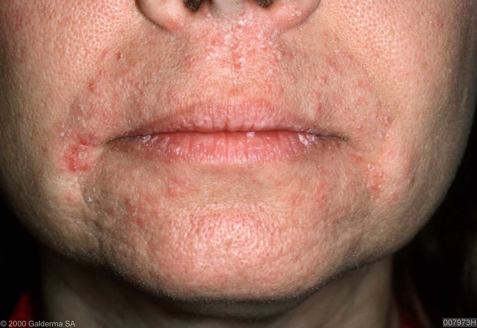 Dermatitis perioral tratamientos