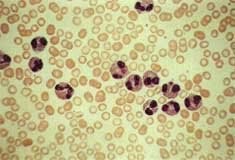 Eosinofilia de celulas maduras