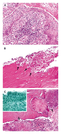 [nejmfig3.gif]